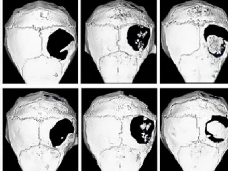    Новый «костный бандаж» ускоряет регенерацию костей на 30%