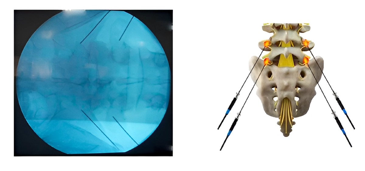  Радиочастотная денервация фасеточных суставов — это метод лечения болей в шее или спине, исходящих из фасеточных суставов.-4