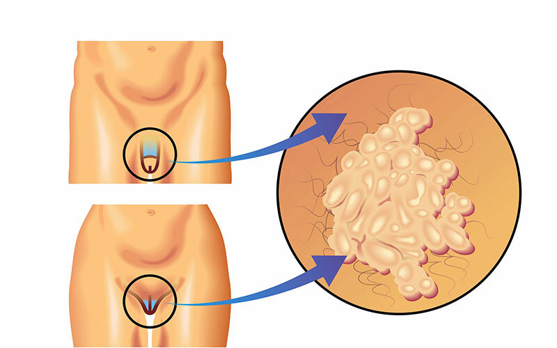 Остроконечные кондиломы у мужчин
