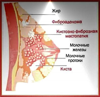 Лечение мастопатии