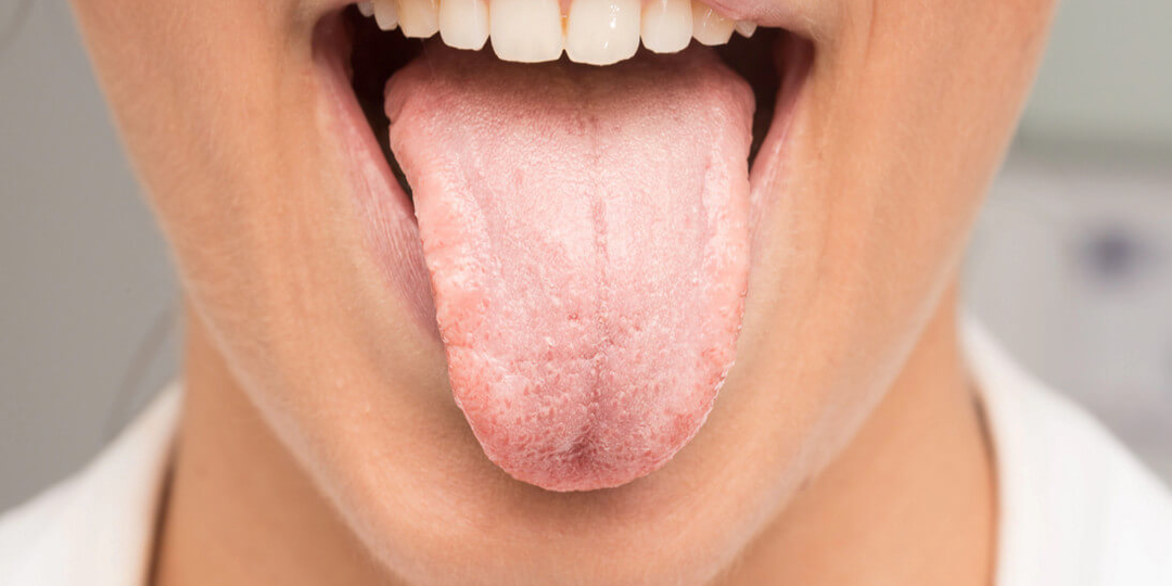 Почему у меня появился налет на языке: когда это норма? О чем может сказать налет?