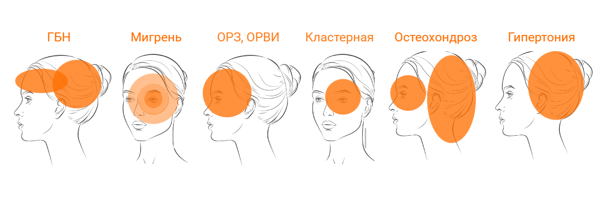Локализация головных болей в зависимости от вида и причины