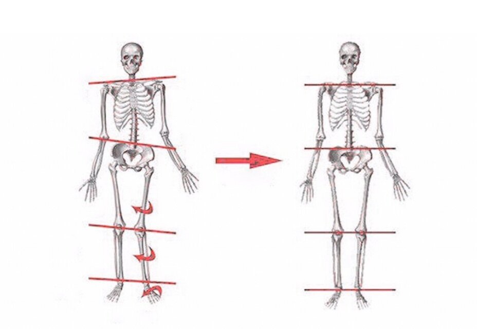 Смещение мышцы. Диспропорция мышц спины. Левосторонний поясничный сколиоз перекос таза. Смещение мышцы. Перекос таза подвздошно-поясничная мышца.