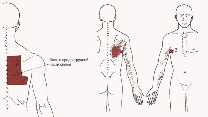 Боли в спине под лопатками: лечение