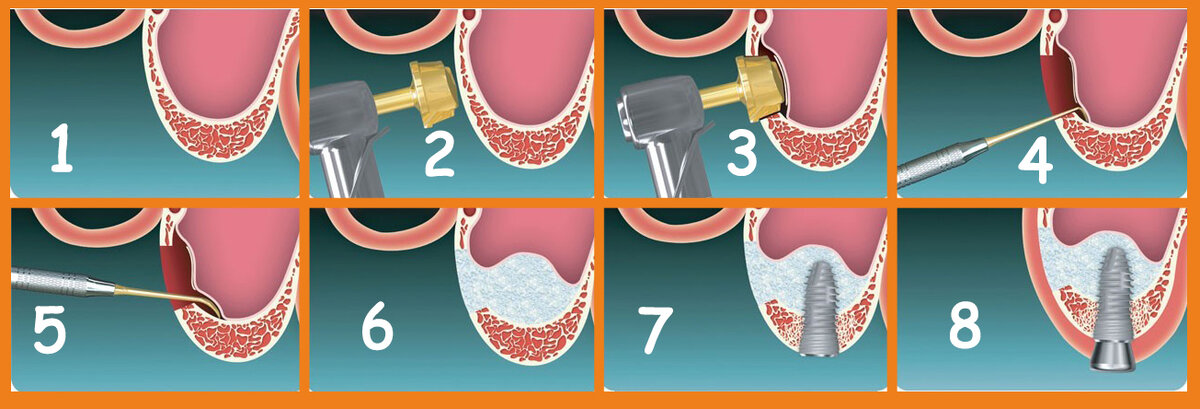 Этапы синус-лифтинга