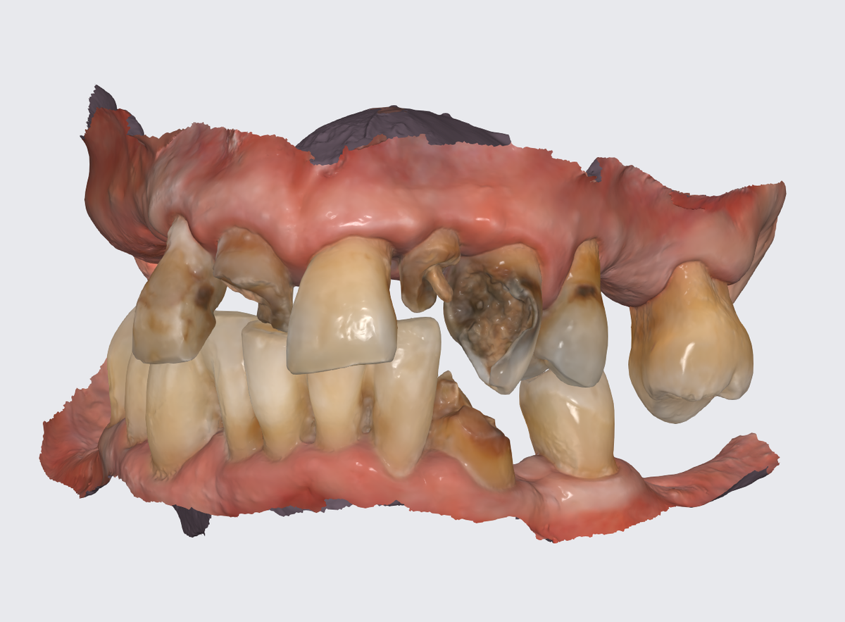 Планирование имплантации по протоколу "всё на 4-х", цифровой слепок челюстей