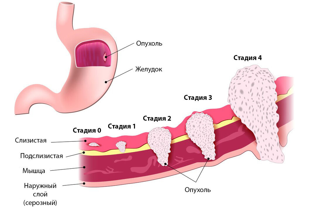 Рак желудка 4 лечение. Опухоль желудка симптомы. Признаки ранга желудка. Онкология желудка симптомы. Симптомы при онкологии желудка.