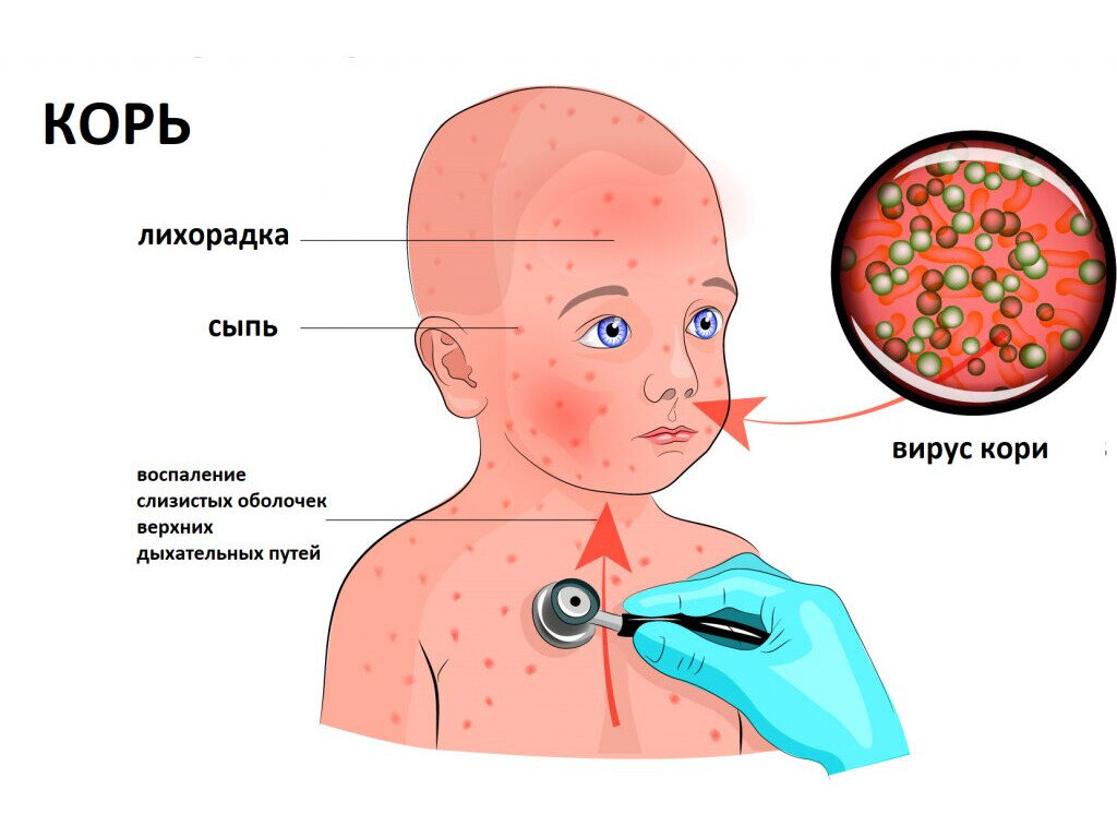 Аллергическая сыпь у детей. Лечение ⚕️ в клинике Элласес - Дерматология Дерматовенеролог в Днепр