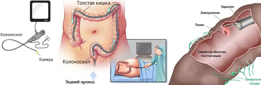 Как выглядит рак на колоноскопии