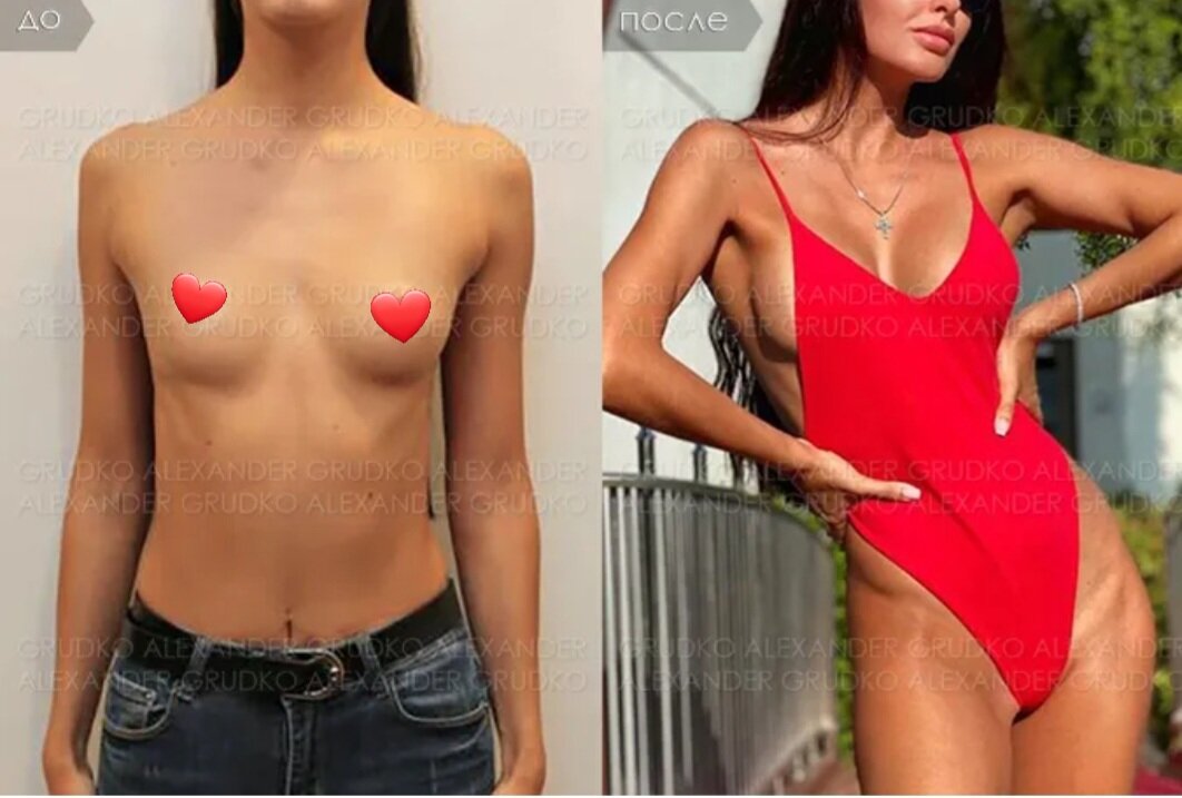 До и после увеличения груди.Пластический хирург Грудко А.В..фото из открытых источников