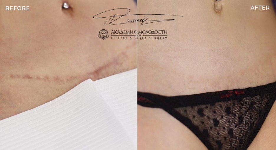 Коррекция Рубца после Абдоминопластики , и предшествующим Кесарево. Перекрытие за 3 процедуры -немецкими пигменатми .