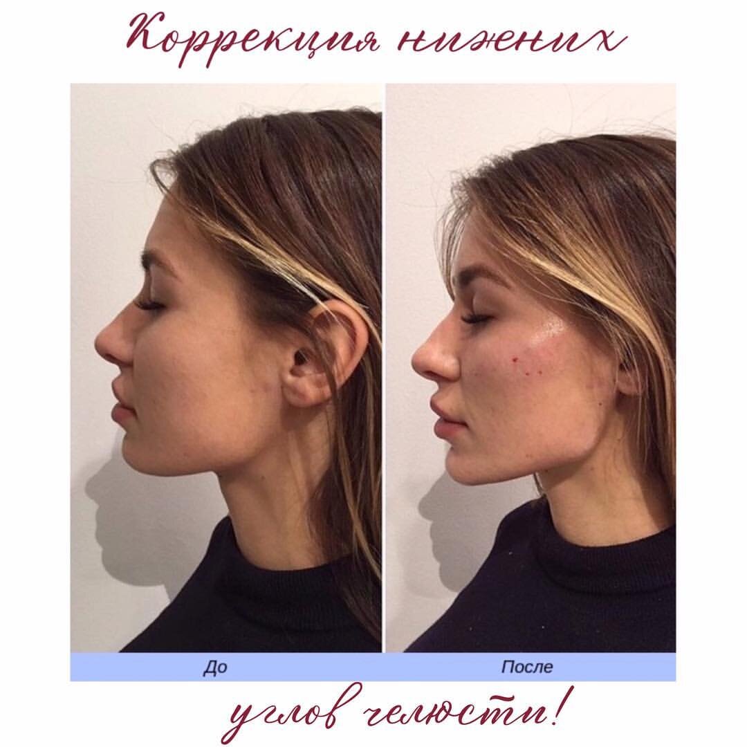 Коррекция подбородка до и после отзывы Скулы-утюги. А в чём прикол? Маша Б-С Дзен
