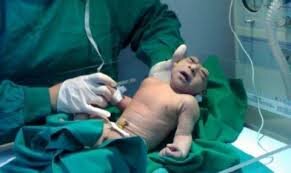 Так выглядит анэнцефалия в реальности. Тягостное зрелище, скажу я вам. 