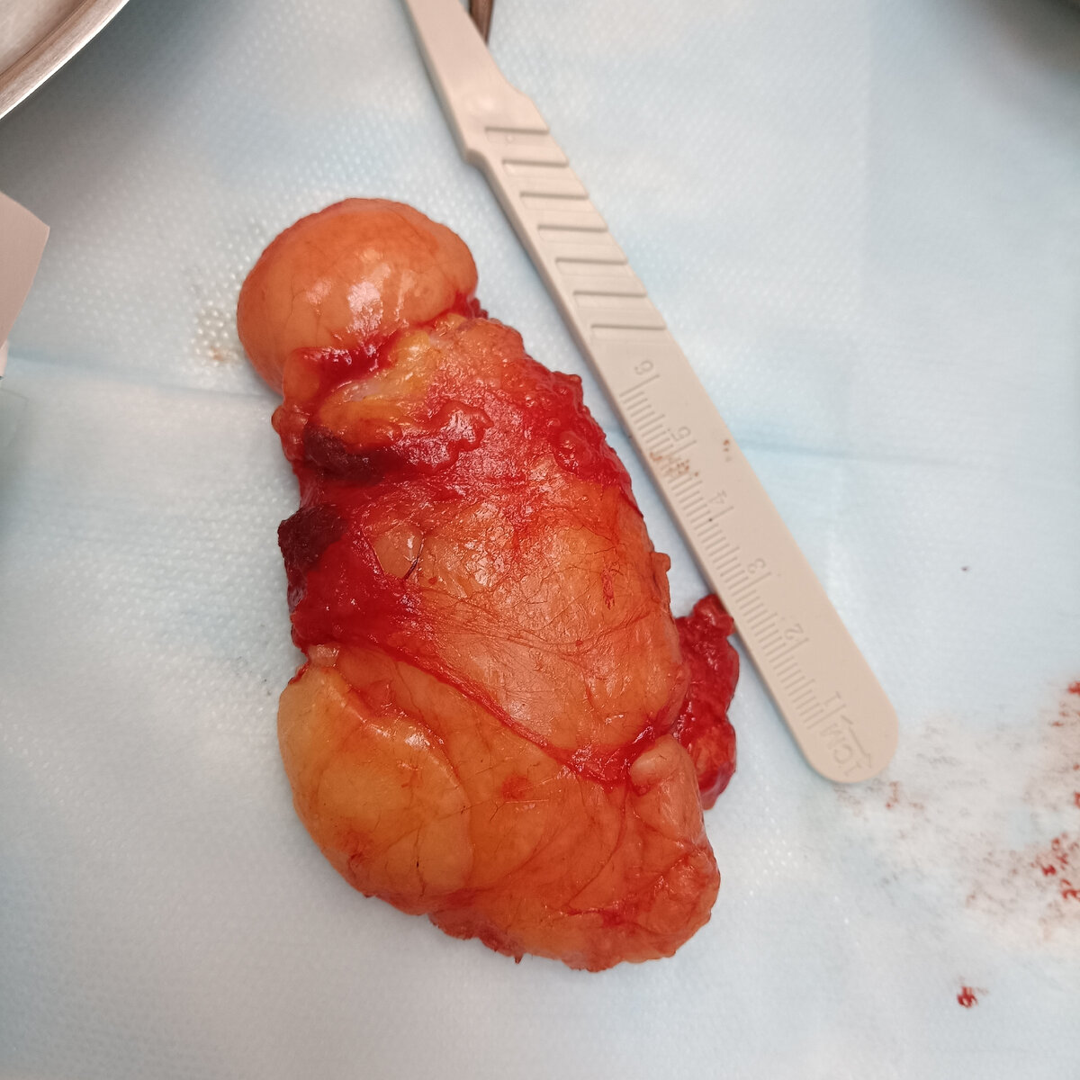 В настоящее время широко внедряется лазерное лечение при геморрое. Многим кажется что это какая то панацея, но с практической точки зрения преимущества совсем не очевидны.  Всё это делается в том числе для увеличения стоимости лечения и соответственно зарабатывания денег медицинским центром. 