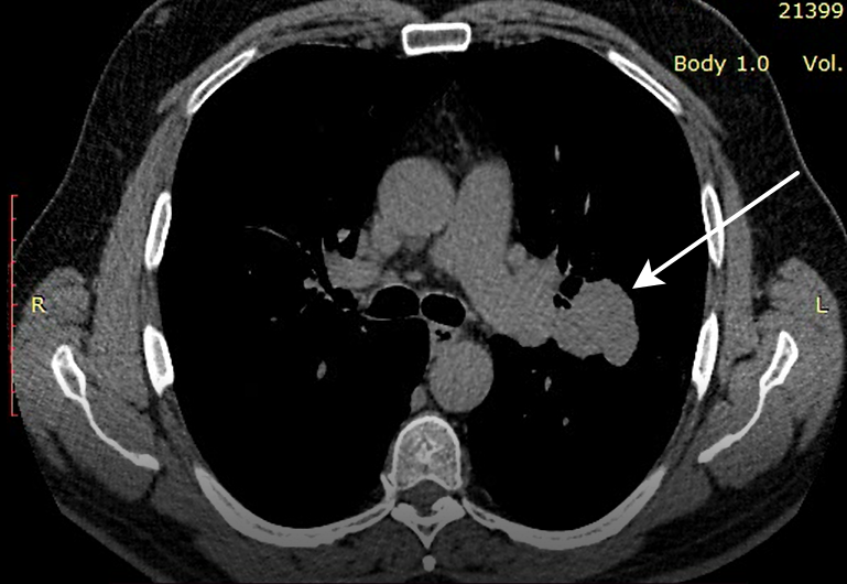 Видно ли рак легких на КТ | MRT-V | Дзен