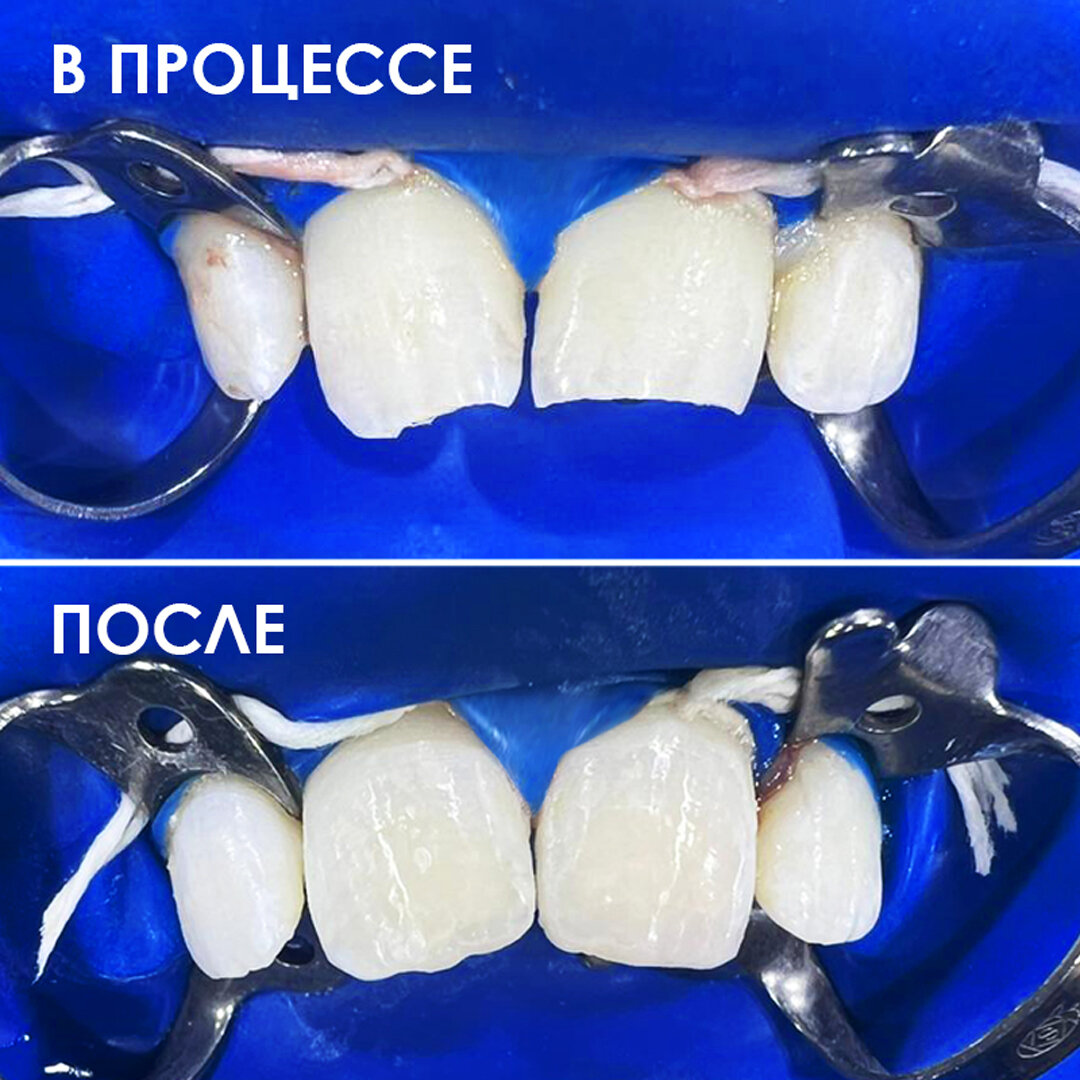 Травма зубов 🦷 на хоккейной площадке – случай из клинической практики  детского стоматолога Смирновой Е.Г. | Клиника Здоровья Исток | Дзен