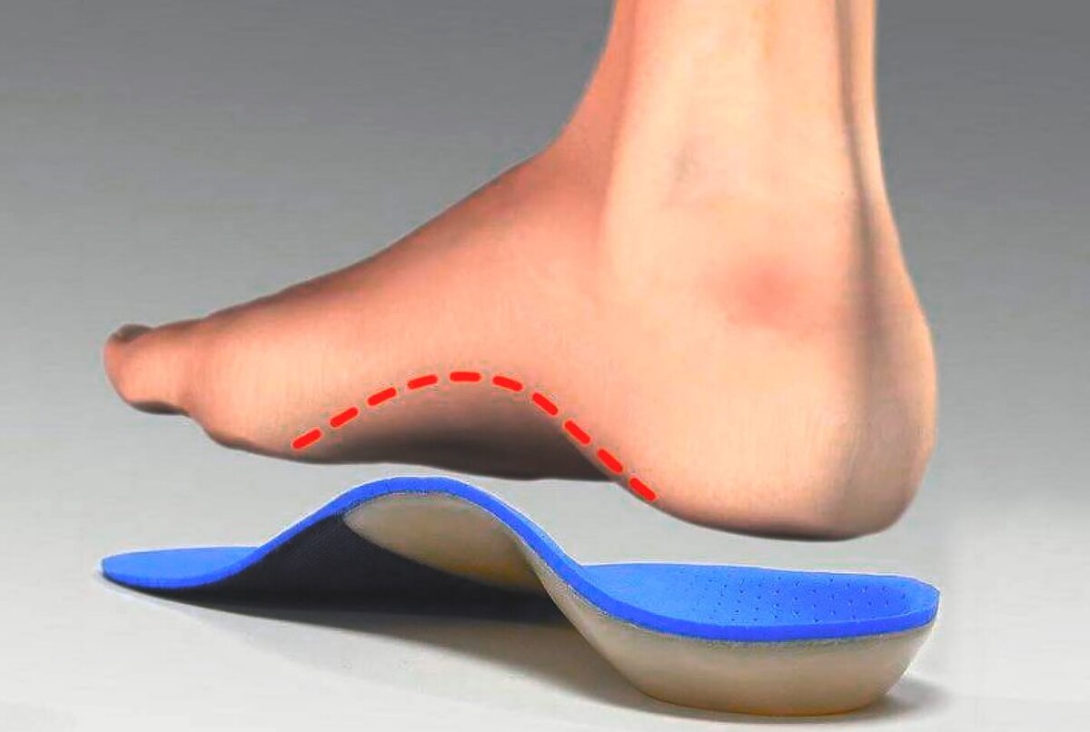 Та область которую поддерживает стелька в норме должна расплющиваться, а потом снова подниматься куполом за счет мышц при правильной работе стопы.