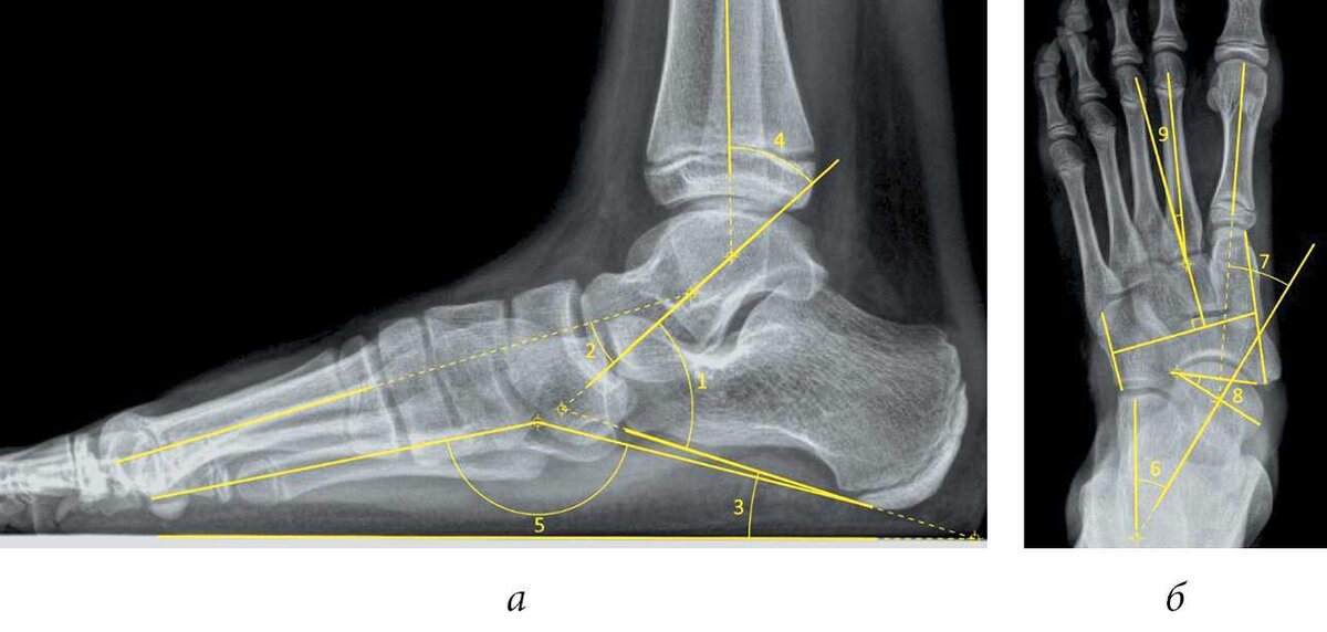 Кости и мышцы устроены так, чтобы гасить ударную нагрузку при ходьбе. Стельки мешают природной работе.