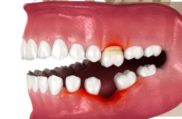 Подготовка к установке имплантатов. Сколько служат зубы на имплантах. Коронка на имплант нобель. Этапы имплантации зубов. Срок службы зубного импланта.