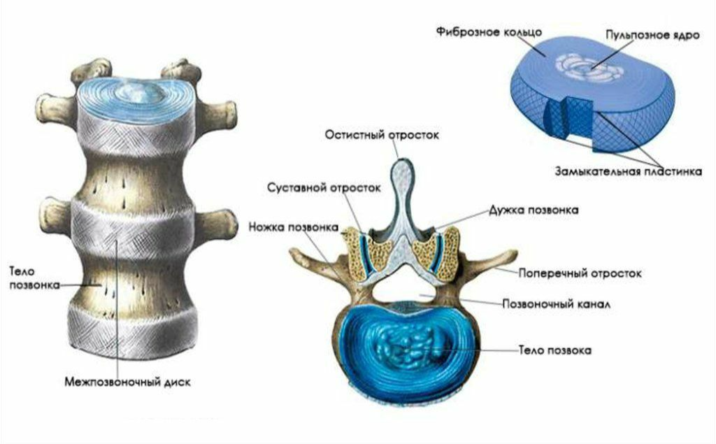 Экструзии межпозвонковых дисков