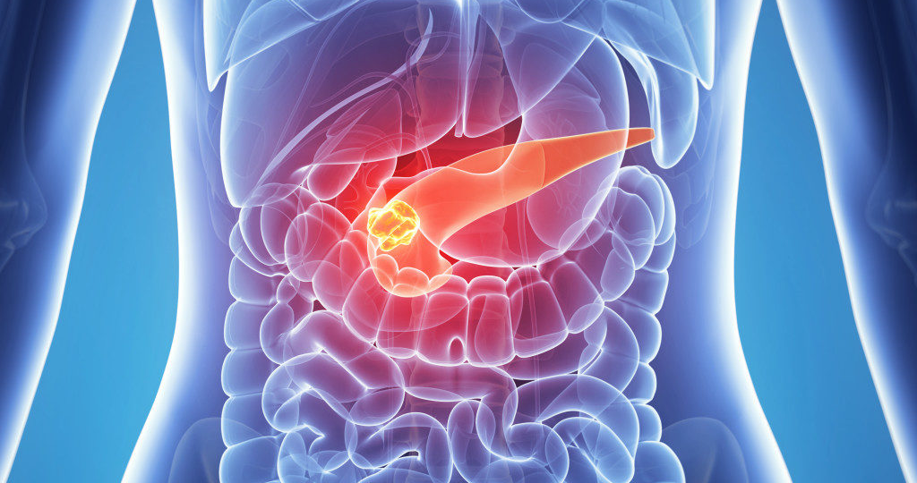 Мне поставили диагноз – панкреатит: что это такое и как с этим жить? Отвечает врач