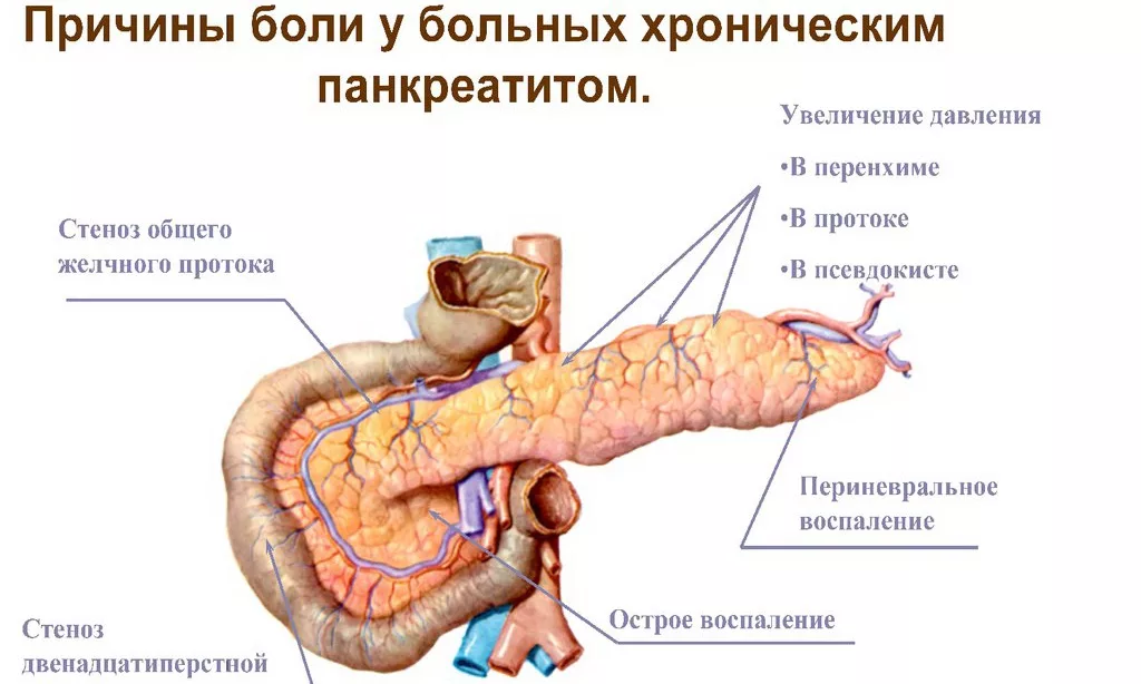 Хронический панкреатит