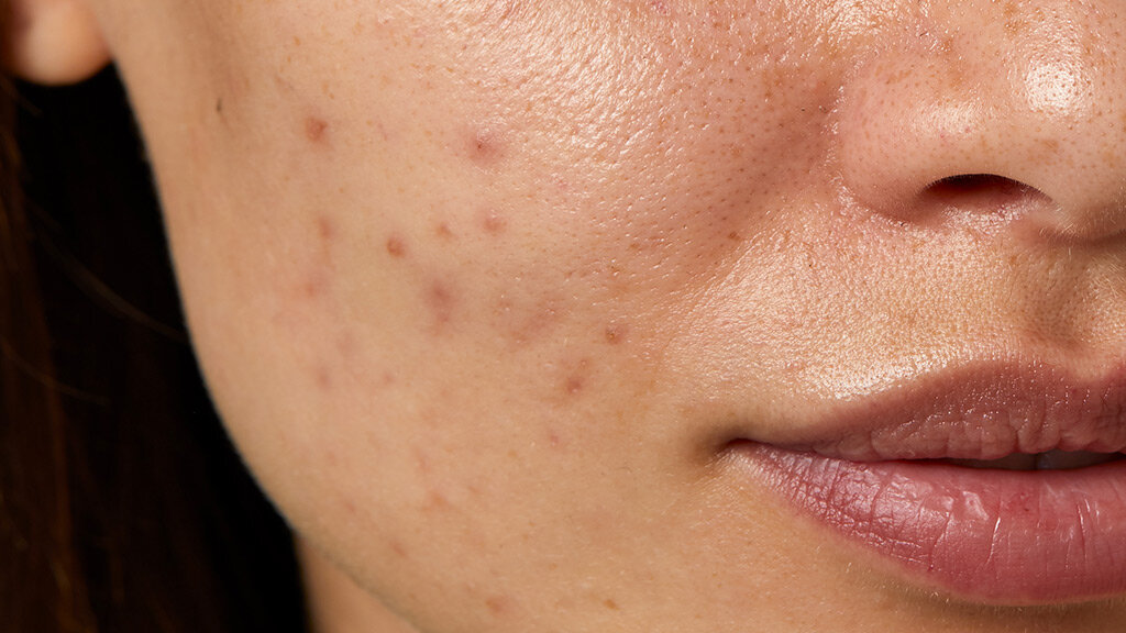 Акне после 30: подростковый возраст давно позади, но всё ещё есть прыщи