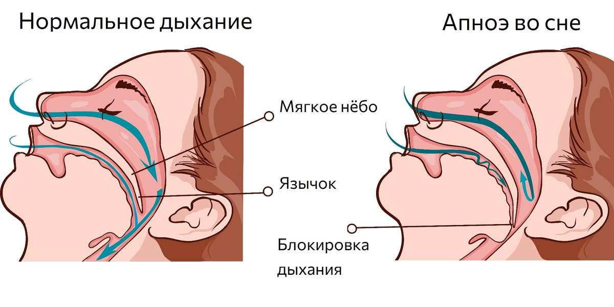 Стенки дыхательных путей не спадаются поэтому воздух в них свободно движется