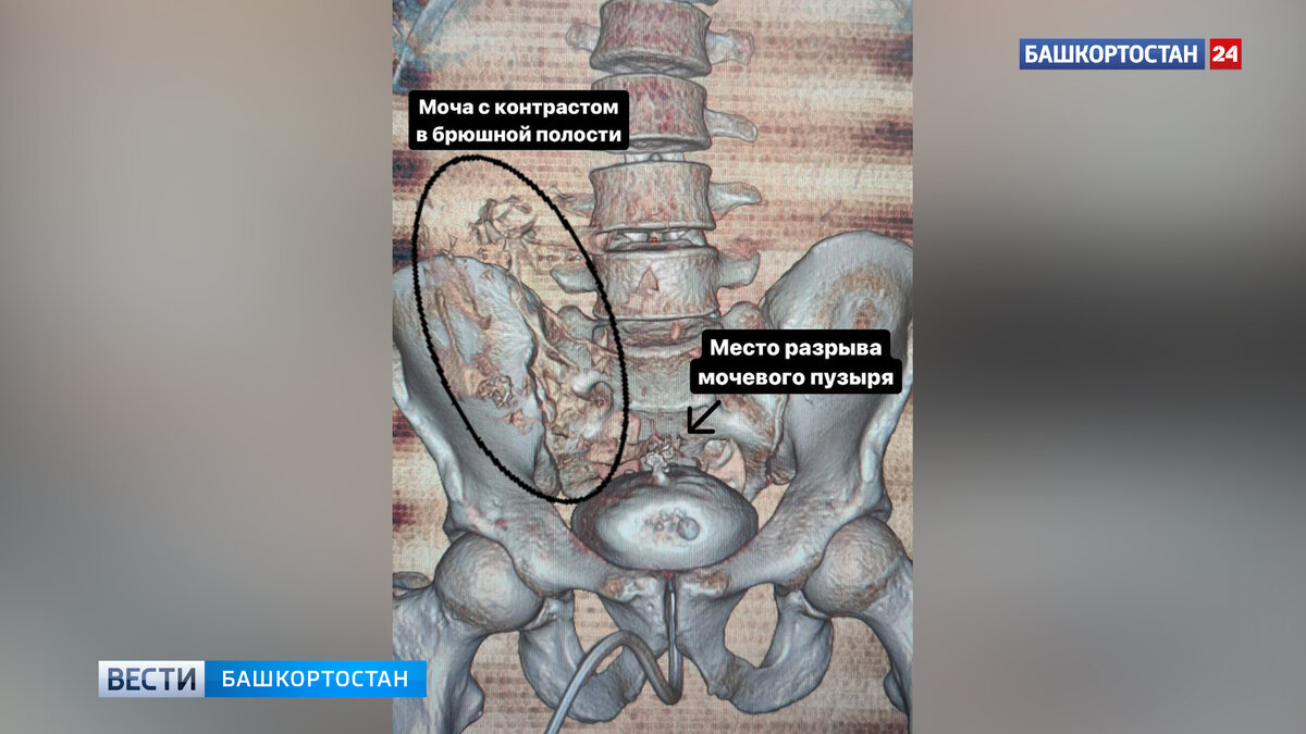    В башкирском Салавате врачи спасли 45-летнего мужчину с разрывом мочевого пузыря