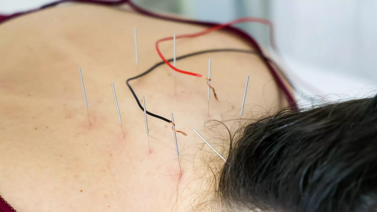     Тайваньские ученые провели масштабное исследование, в ходе которого выяснили, что иглоукалывание может снизить вероятность инсульта. Для этого они изучили базу из 47,8 тыс. пациентов с ревматоидным артритом, последствием которого нередко становятся сердечно-сосудистые заболевания, включая инсульт.