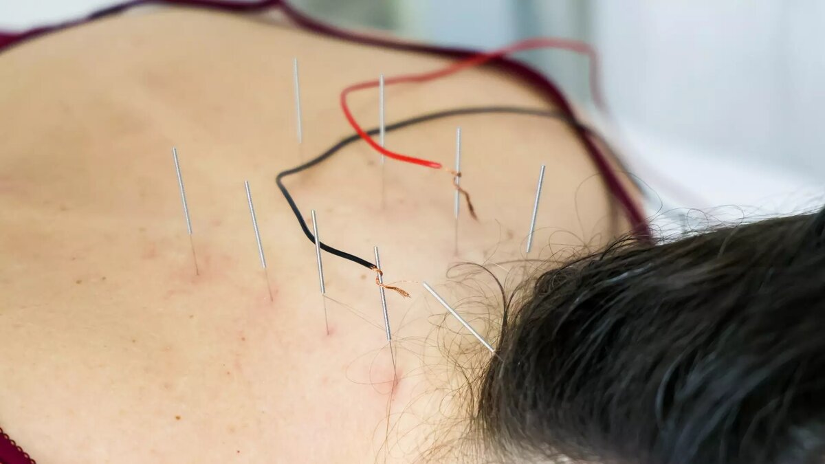 Ученые доказали, что иглоукалывание снижает вероятность инсульта | НОВЫЕ  ИЗВЕСТИЯ | Дзен