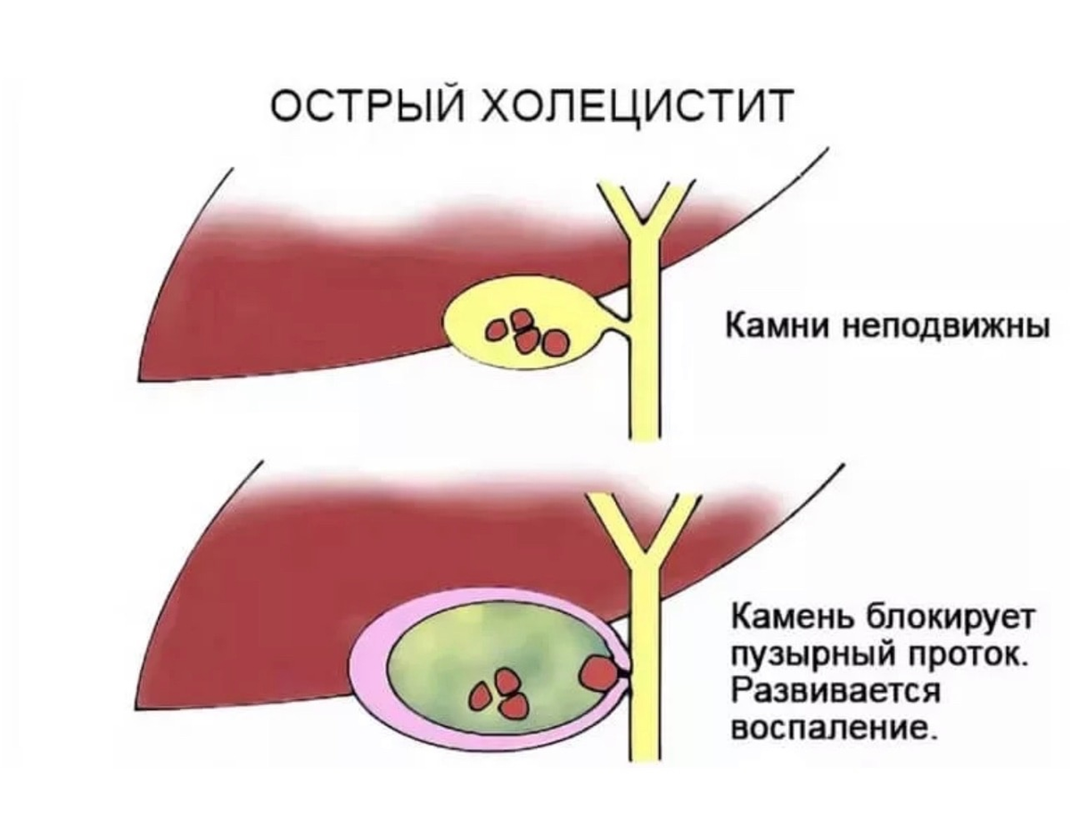 Факторы хронического холецистита