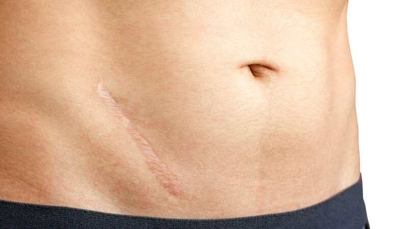 Рубцы после операций могут приводить к невидимым последствиям - нарушение пищеварения, спайки, варикоз, нарушение осанки