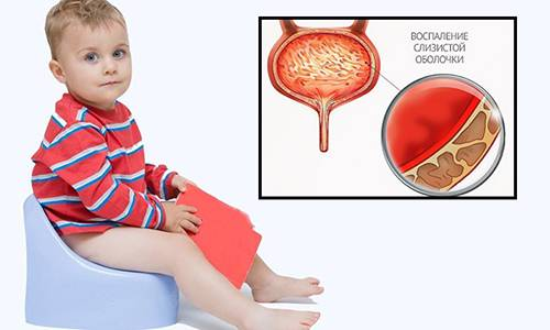 Цистит у детей. Первые симптомы и лечение