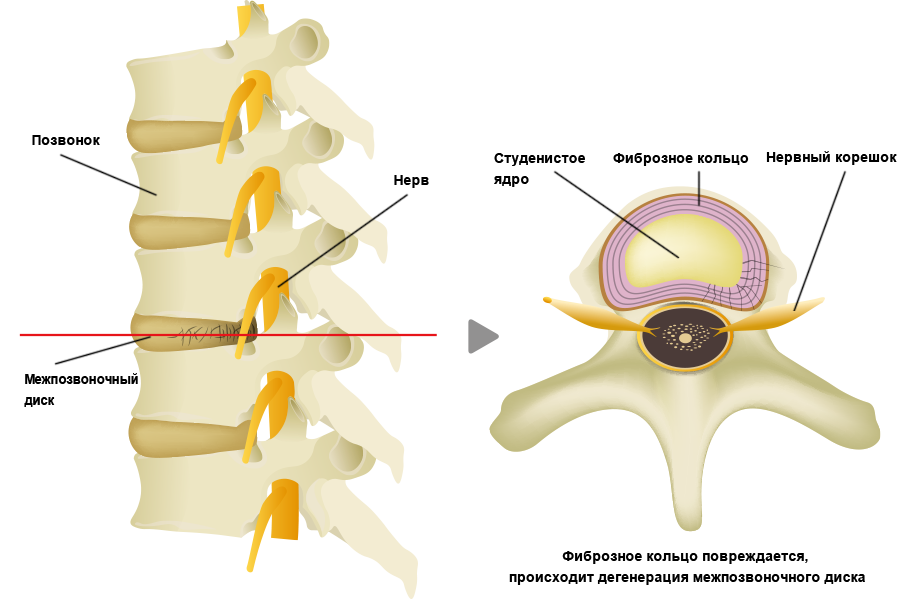 Заболевания межпозвоночных дисков. Студенистое ядро межпозвоночного диска. Межпозвонковый диск студенистое ядро. Фиброзное кольцо и студенистое ядро. Фиброзное кольцо межпозвоночного диска студенистое.