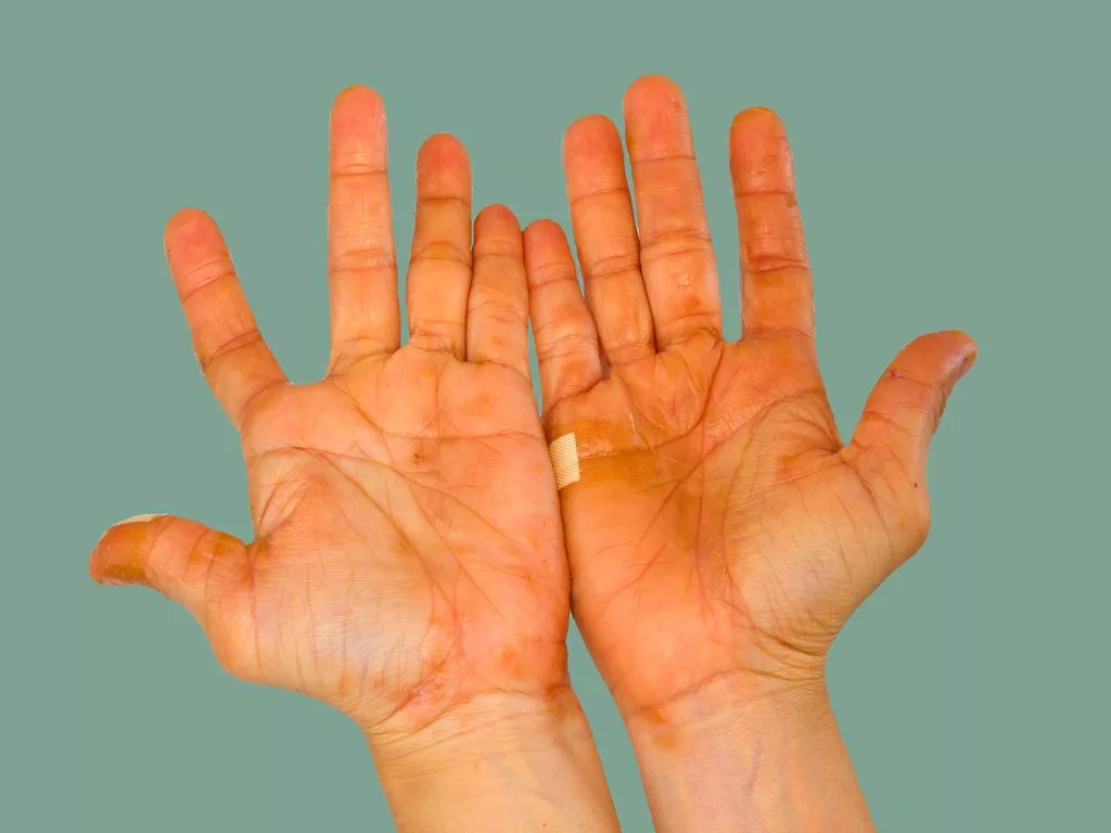 мокрые подмышки. сильное потовыделение. сильное потовыделение. повышенное потоотделение. потливость.