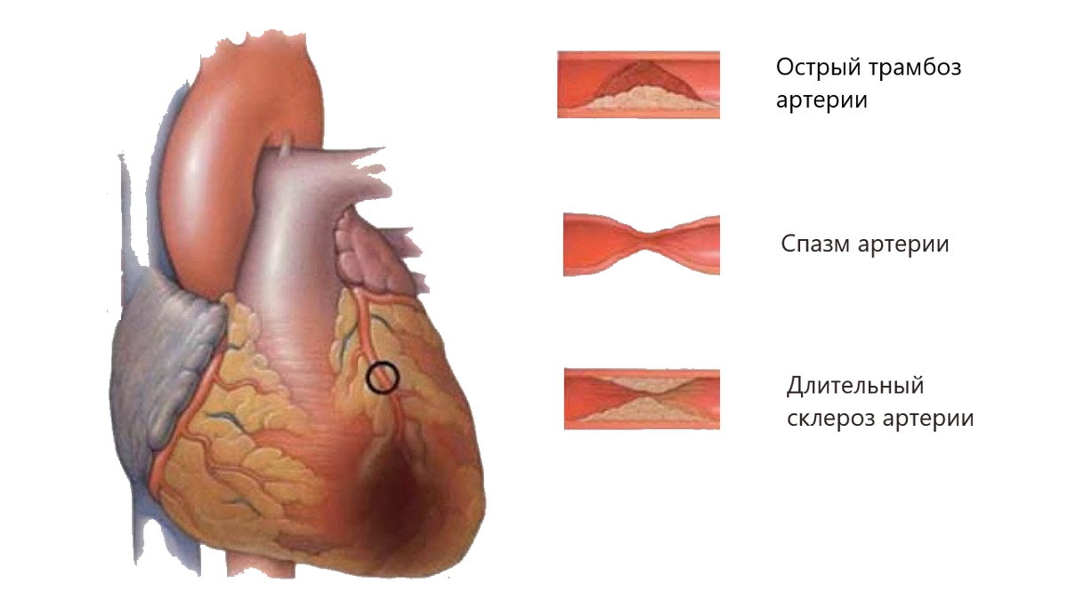 Варианты остановки кровоснабжения в сердце.