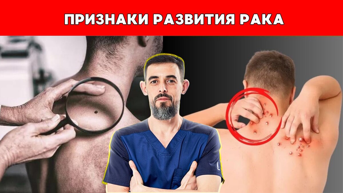 Врач поделился 9 признаками рака, которые можно самостоятельно распознать |  Томаш Игорь | Pro Training | Дзен