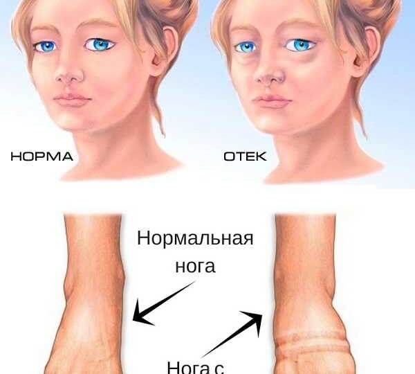 Как быстро избавиться от отеков