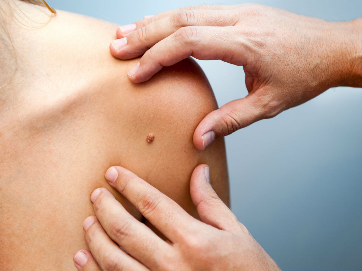 Удаление новообразований