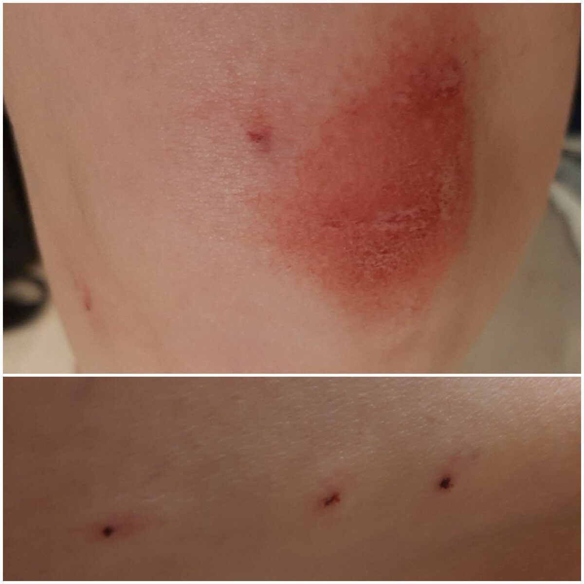 место укуса и и царапок