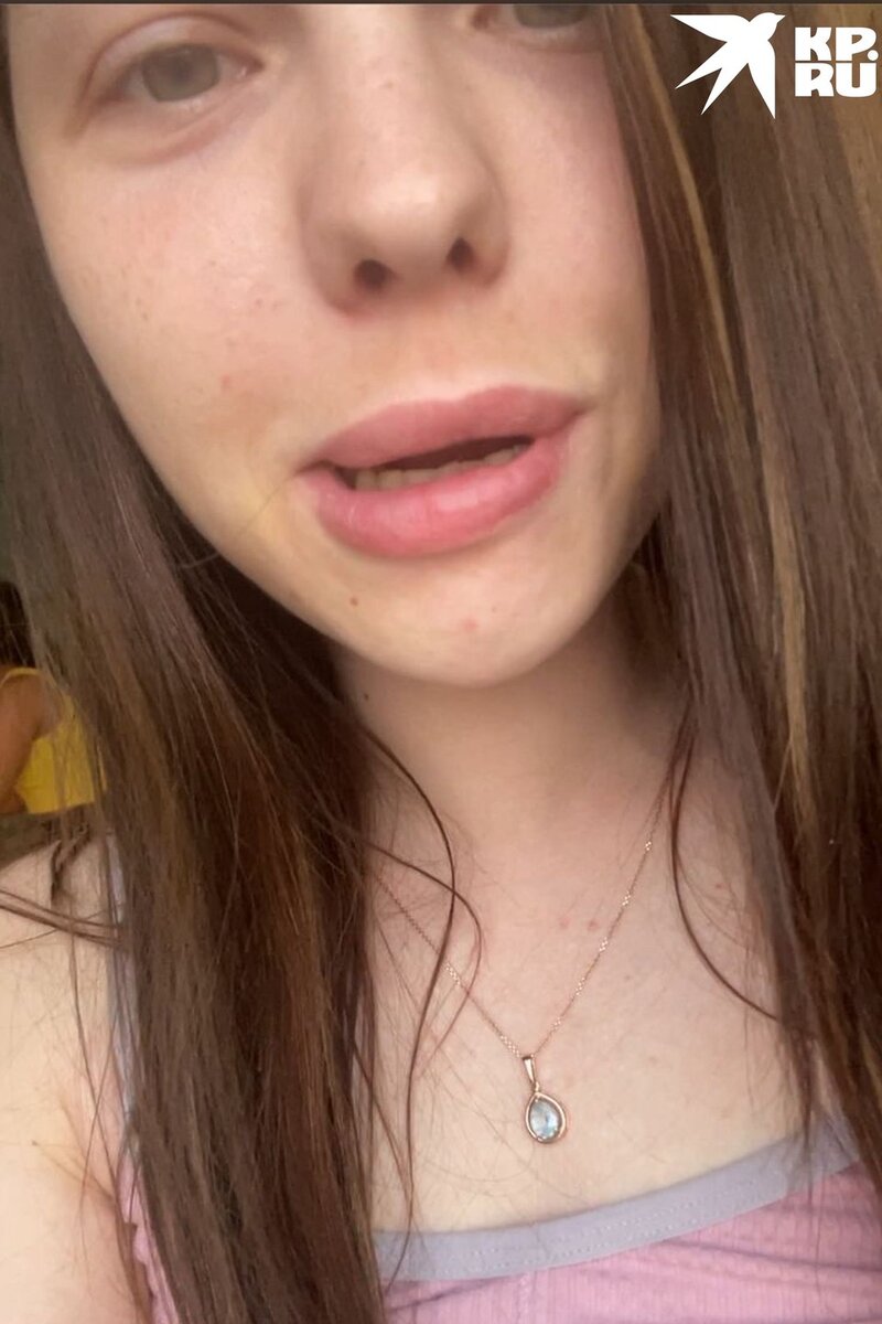 Лицо перекосило на следующий день. Фото: предоставлено Еленой