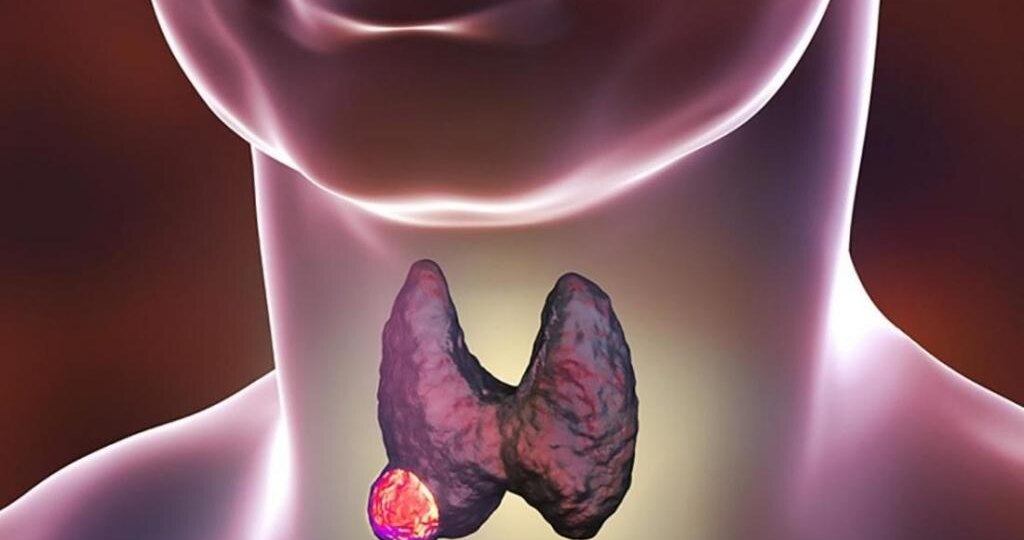Узлы в щитовидной железе — главное, что нужно знать