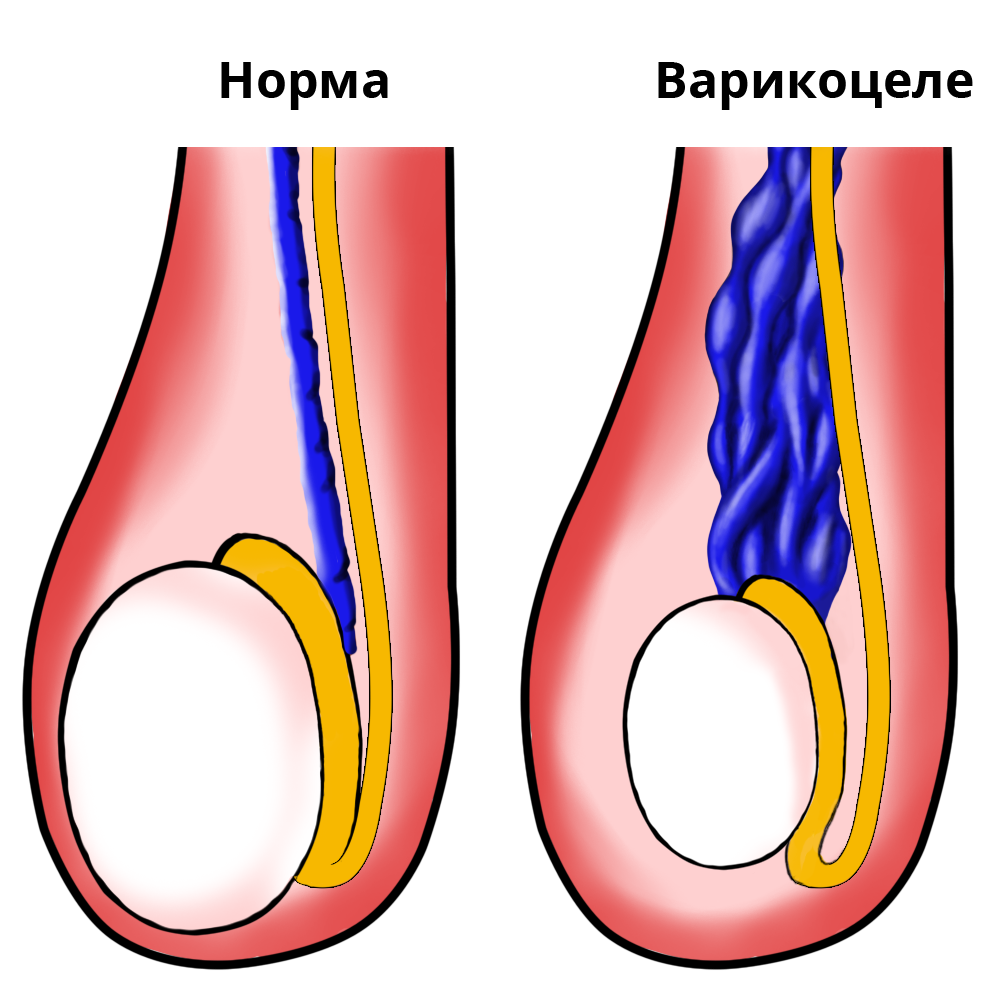 Яйцо ниже другого у мужчин. Варикоз вен семенного канатика. Варикозное расширение вен мошонки. Варикозное расширение вен семенного канатика III степени. Варикоцеле-расширение вен семенного канатика яичка.