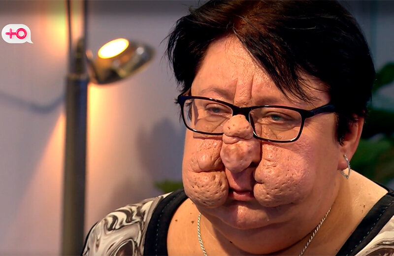  Наталья до операции. Фото: скриншот с видео программы «Я стесняюсь своего тела»