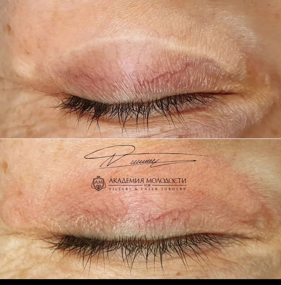 Камуфлирование рубца после блефаропластики 