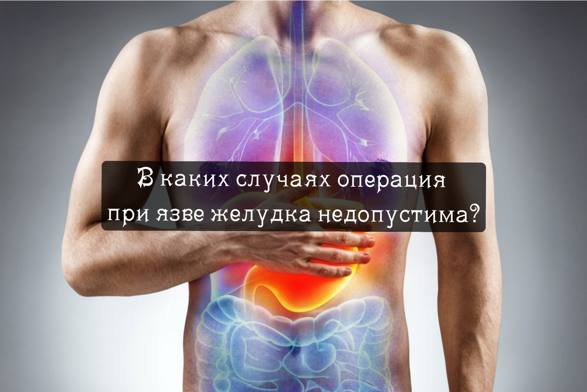 В каких случаях операция при язве желудка недопустима? | Просто о сложном  (советы хирурга, травматолога-ортопеда) | Дзен