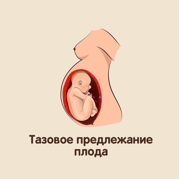 Тазовое предлежание плода