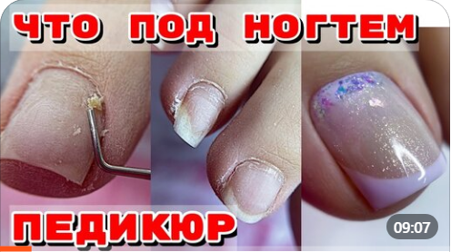 подногтевые мозоли педикюр