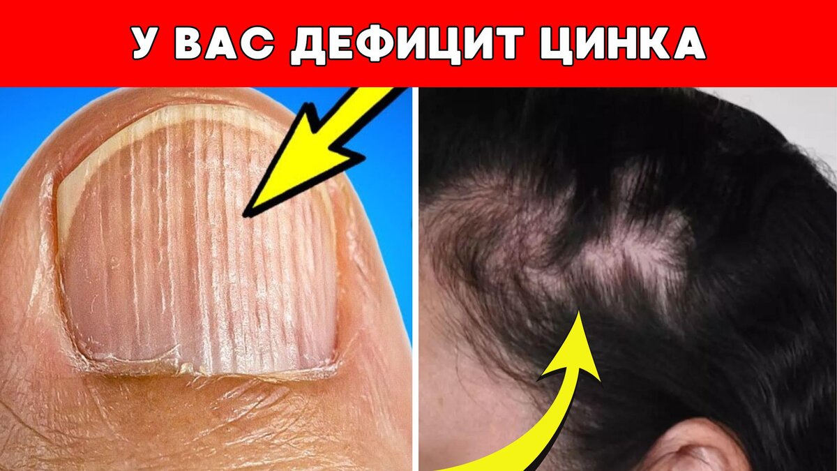 Дефицит цинка у женщин